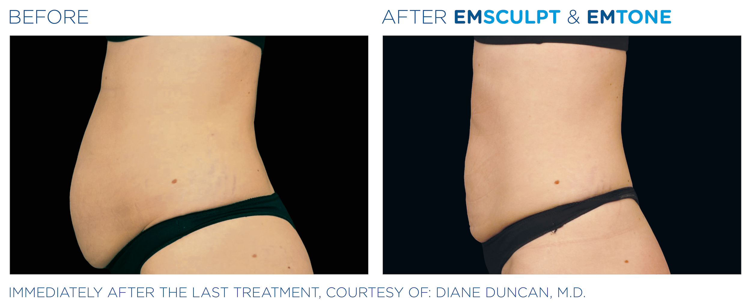 Emsculpt Emtone Abdomen