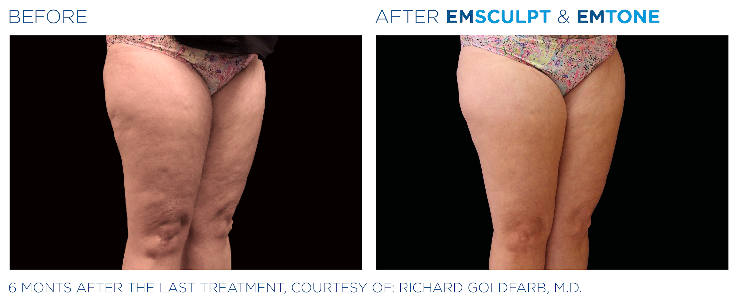 Emsculpt Emtone thighs