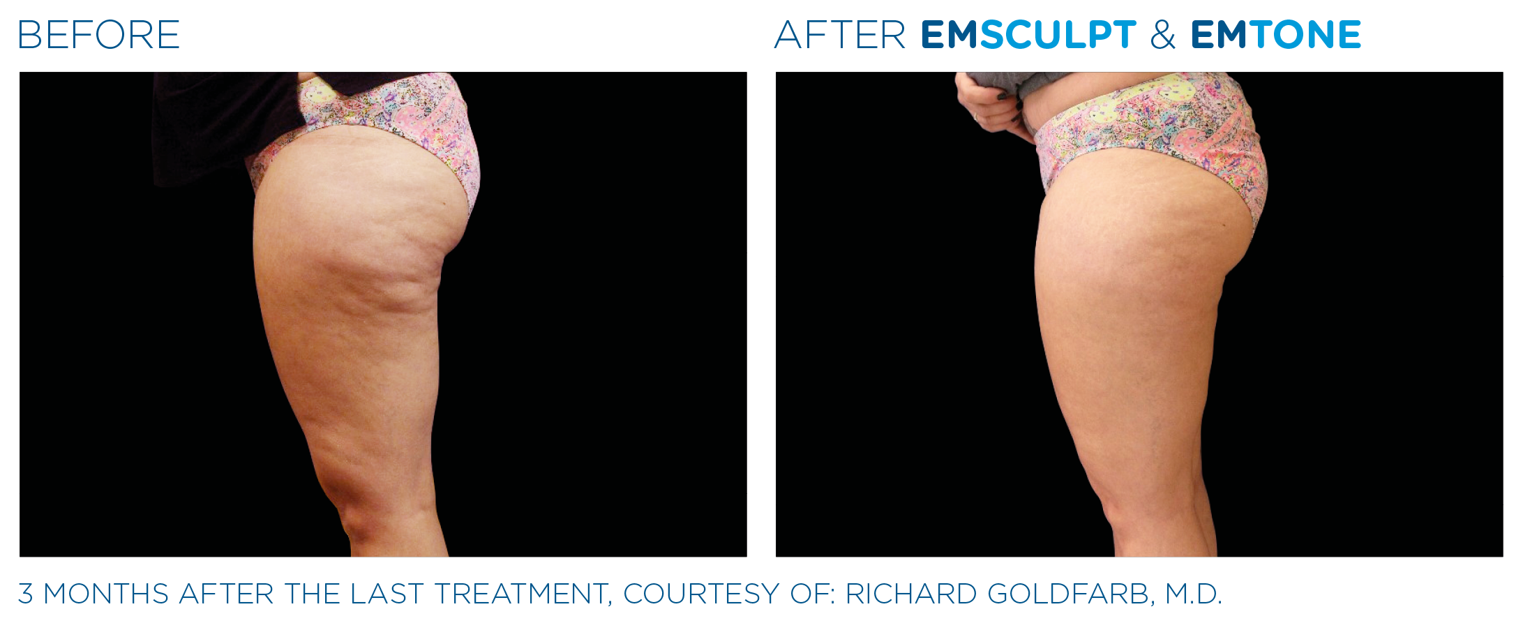 Emsculpt Emtone buttocks