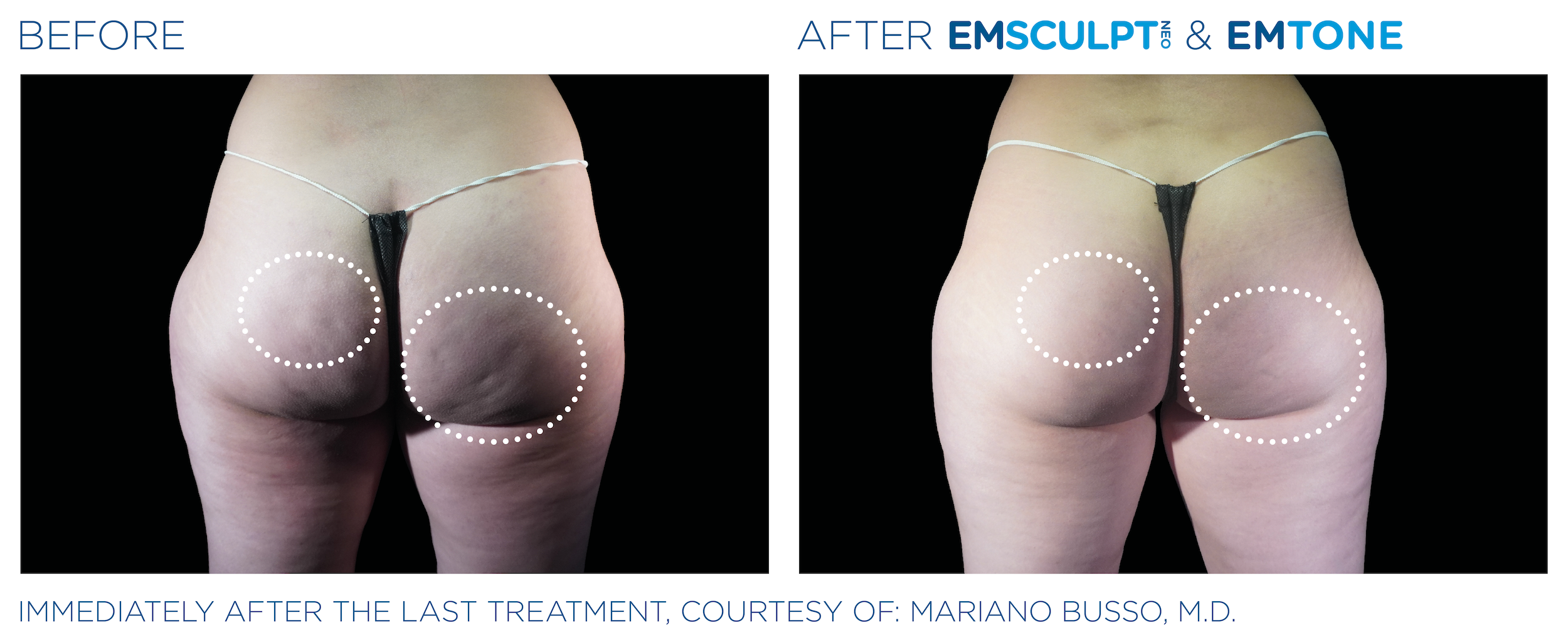Emsculpt Neo Emtone buttock