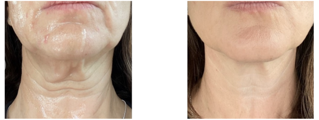 Sofwave before and after